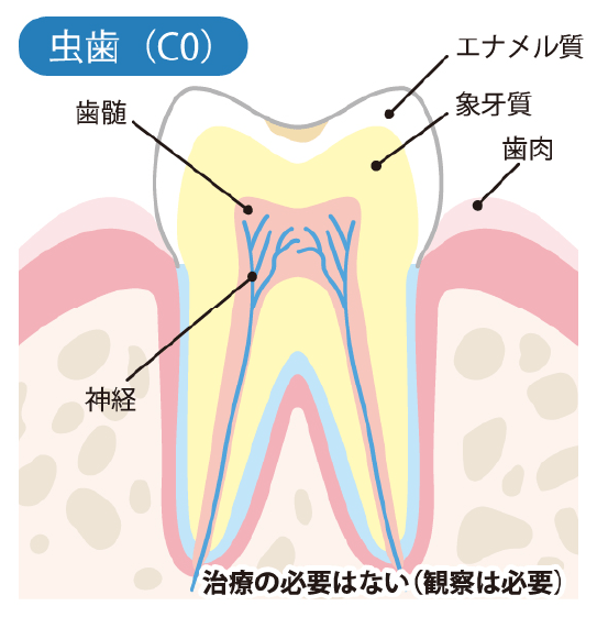 ごく初期の虫歯