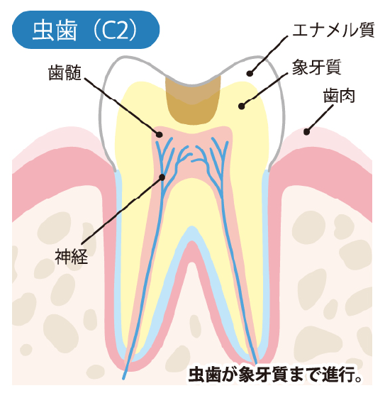 象牙質の虫歯