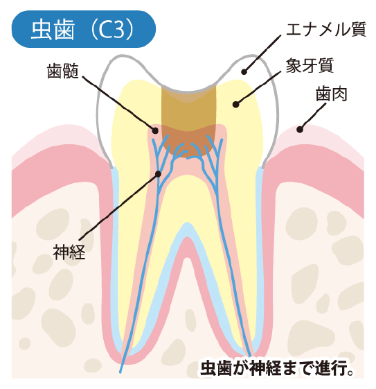 神経に達した虫歯