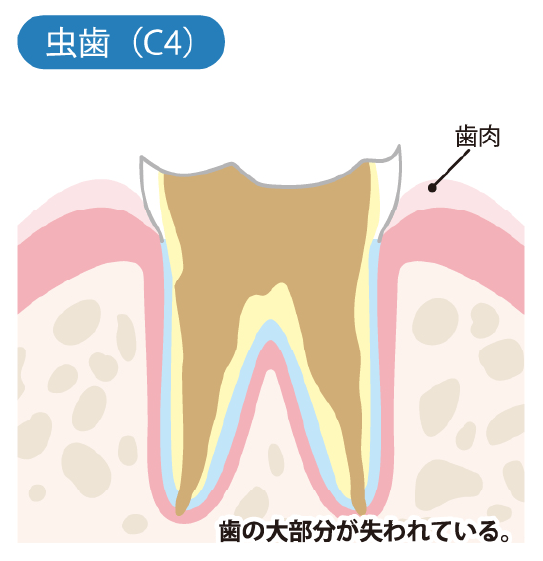 歯根まで達した虫歯