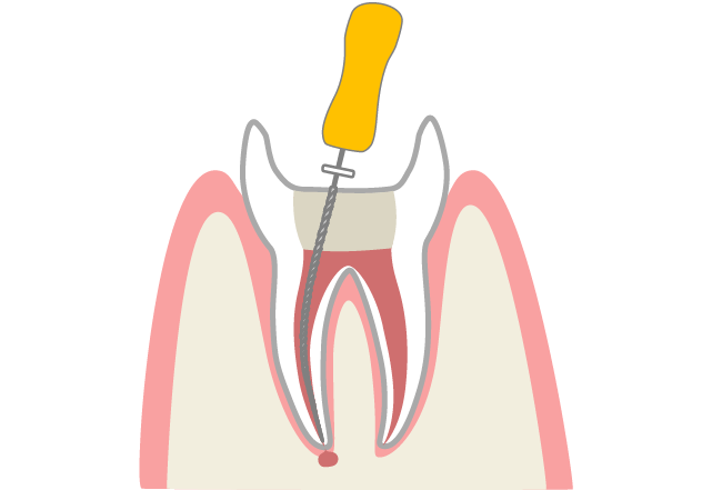 根管内の神経や汚れを取り除く